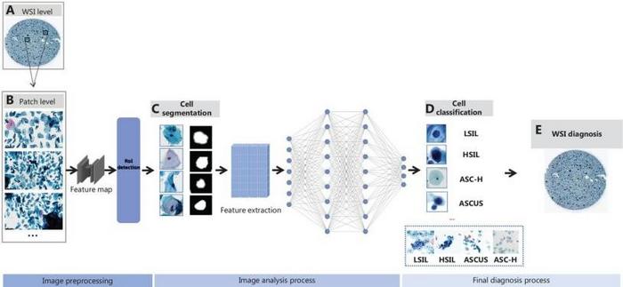 smart-advances:-ai-revolutionizes-cervical-cancer-detection
