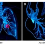 lung-metastasis-aspartate