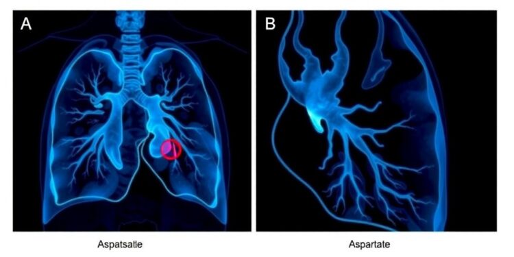 lung-metastasis-aspartate