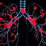 outcome-risk-associated-clonal-lung-expression