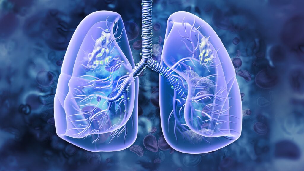 os-therapies’-her2-drug-prevented-lung-cancer-from-returning-in-a-3rd-of-patients