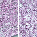 promising-drug-for-breast-cancer-shows-potential-in-treating-certain-blood-cancers