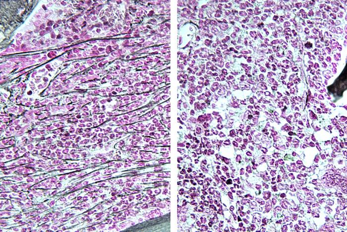 promising-drug-for-breast-cancer-shows-potential-in-treating-certain-blood-cancers