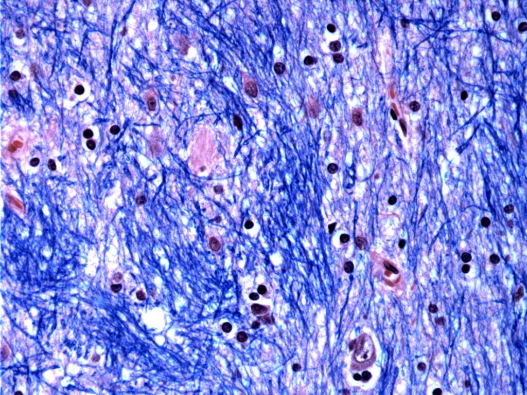 groundbreaking-huntington-study-reveals-somatic-dna-repeat-expansion