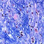 groundbreaking-huntington-study-reveals-somatic-dna-repeat-expansion