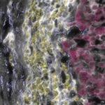 distinctive-features-of-a-rare-liver-cancer-unveiled-as-new-treatment-clinical-trial-launches