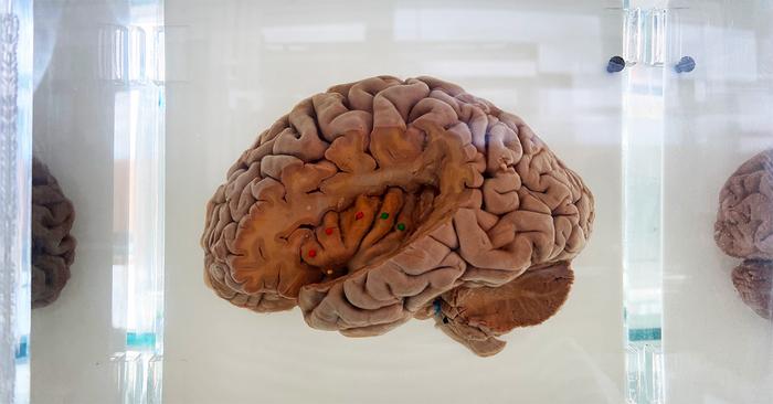 mapping-the-brain’s-remarkable-self-healing-mechanisms-following-stroke
