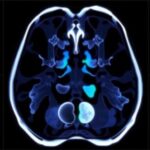 jnm-releases-new-standardized-guidelines-for-fibroblast-activation-protein-pet-procedures