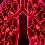 new-insights-uncover-why-lungs-are-common-targets-for-cancer-metastasis