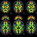 research-focus:-enhancing-brain-cancer-outcome-predictions-through-optimal-imaging-criteria