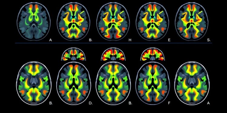 research-focus:-enhancing-brain-cancer-outcome-predictions-through-optimal-imaging-criteria