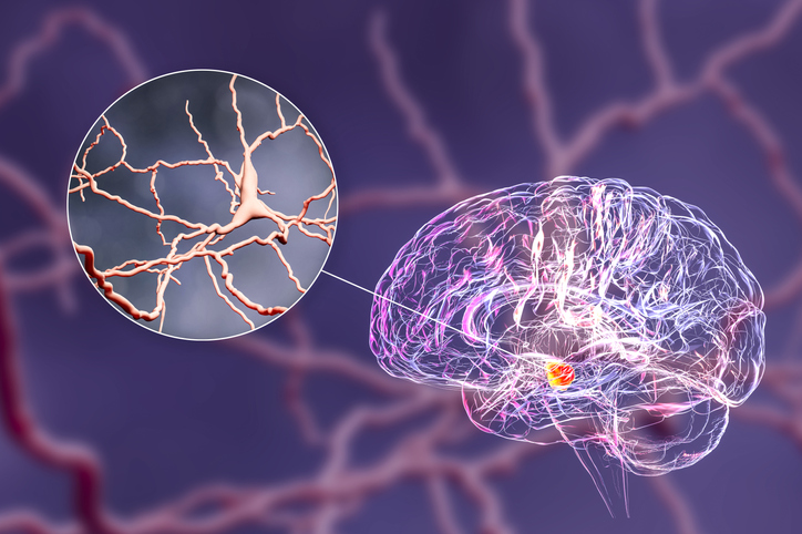 ketamine-reduces-l-dopa-related-uncontrolled-movements-in-parkinson’s-rat-model
