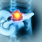 enzyme-found-to-fuel-tumor-growth-in-pancreatic-cancer