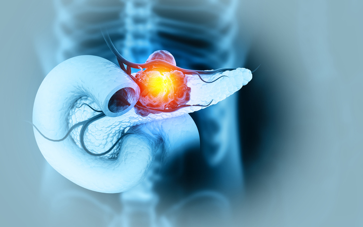 enzyme-found-to-fuel-tumor-growth-in-pancreatic-cancer