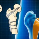 new-clinical-trial-aims-to-identify-optimal-treatments-for-common-hip-fractures-in-older-adults