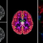 co-located-cell-types-play-a-key-role-in-promoting-aggressive-brain-tumors