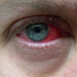 revolutionary-stem-cell-injections:-a-safer-approach-to-treating-inflammatory-eye-diseases