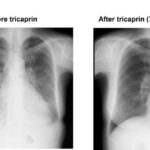 novel-heart-disease-treatment:-a-basic-supplement-enhances-patient-survival-rates