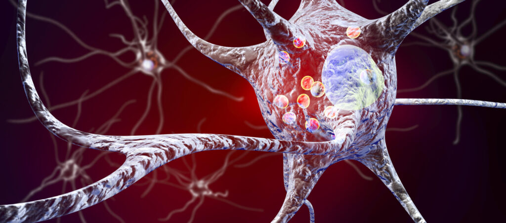 cholesterol-metabolite-implicated-in-parkinson’s-disease-pathology