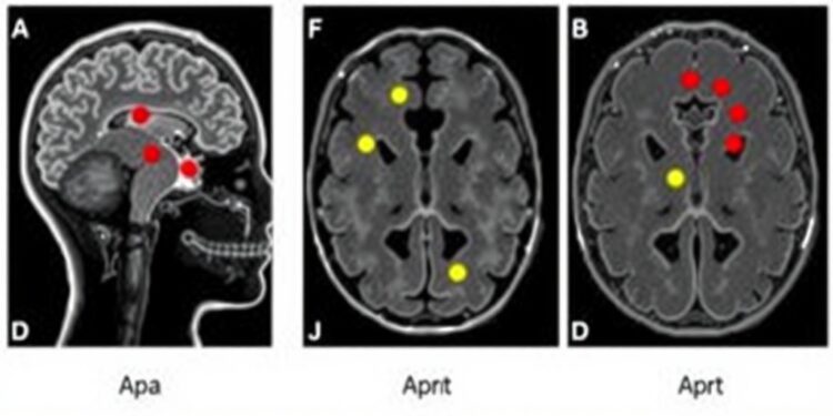 revolutionary-ai-identifies-hidden-brain-abnormalities-in-epileptic-children