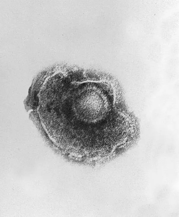 awakening-threat:-the-role-of-vzv-reactivation-in-central-nervous-system-infections
