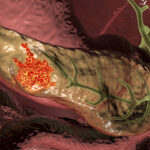 extrachromosomal-dna-carrying-myc-drives-pancreatic-cancer-aggression