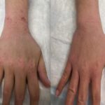 nih-researchers-establish-diagnostic-criteria-for-topical-steroid-withdrawal