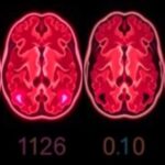 groundbreaking-therapeutic-advancements-for-pediatric-brain-tumors