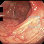 promising-advances-in-ai-technology-signal-a-future-for-colon-cancer-detection