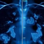 revolutionizing-heart-health:-ai-enhanced-mammograms-offer-new-insights
