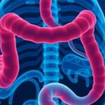 colorectal-cancer-associated-with-elevated-risk-of-cardiovascular-mortality