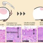 revolutionary-ultrafine-bubble-showers-show-promise-in-treating-atopic-dermatitis