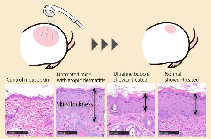 revolutionary-ultrafine-bubble-showers-show-promise-in-treating-atopic-dermatitis