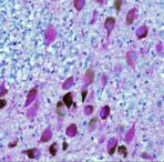 exploring-the-link-between-cholesterol-regulation-and-alzheimer’s-disease-development
