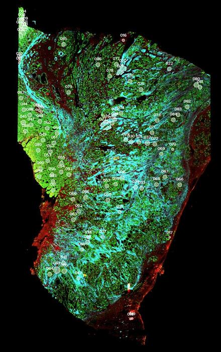 singaporean-researchers-create-tumor-maps-to-enhance-precision-treatment-for-stomach-cancer
