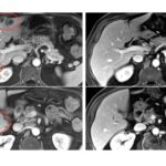 combination-immunotherapy-demonstrates-efficacy-in-reducing-metastatic-gastrointestinal-cancers