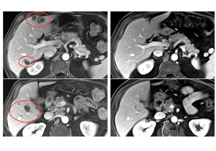 combination-immunotherapy-demonstrates-efficacy-in-reducing-metastatic-gastrointestinal-cancers