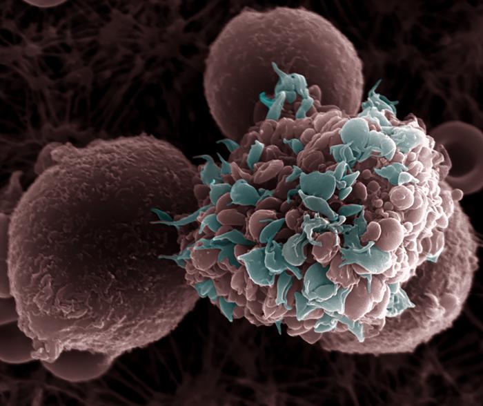 high-fat-diet-linked-to-increased-breast-cancer-metastasis-in-animal-studies