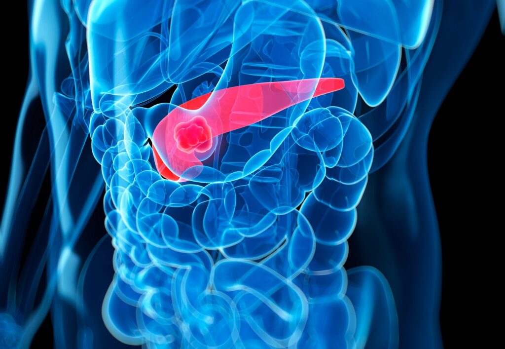 inhibiting-fgfr2-supports-prevention-and-delay-of-common-pancreatic-cancer