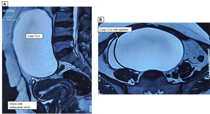 uncommon-co-occurrence-of-ovarian-tumors-detected-in-single-patient