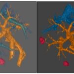 city-of-hope-study-validates-innovative-targeted-strategy-for-treating-pancreatic-cancer