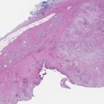 identifying-pancreatic-cancer-subtypes:-the-role-of-‘sugar’-signatures