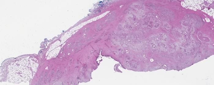 identifying-pancreatic-cancer-subtypes:-the-role-of-‘sugar’-signatures