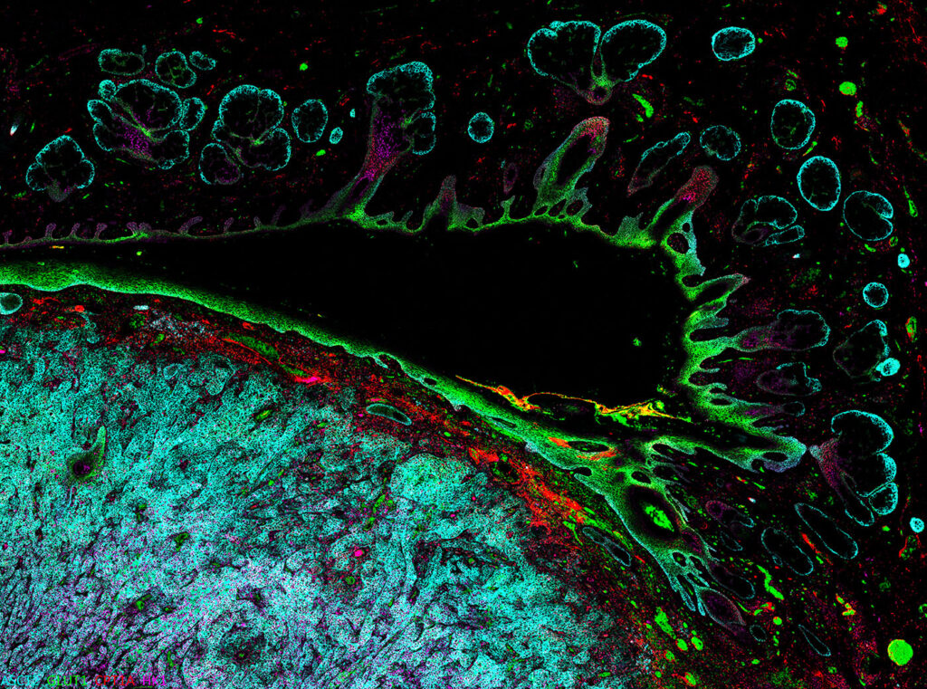 spatial-biology-reveals-past,-present,-and-future-cancer-biology