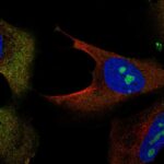 human-cell-maps-uncover-insights-in-pediatric-bone-cancer