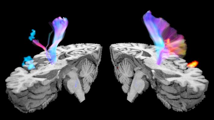 new-usc-research-reveals-crucial-brain-networks-linked-to-post-stroke-urinary-incontinence