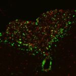 apathy-in-cancer-patients-linked-to-brain-immune-circuit