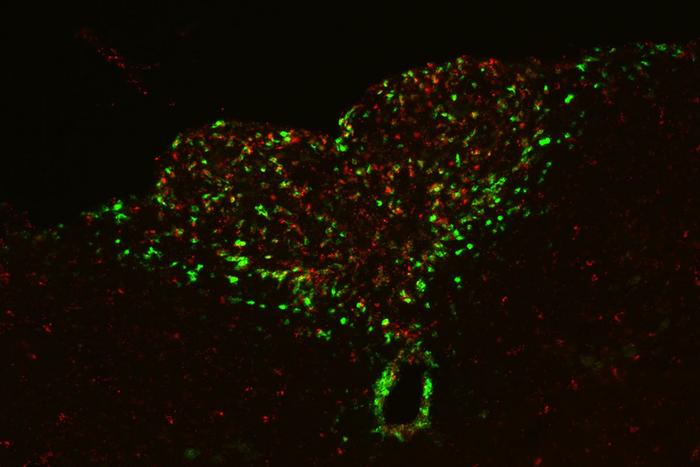 apathy-in-cancer-patients-linked-to-brain-immune-circuit