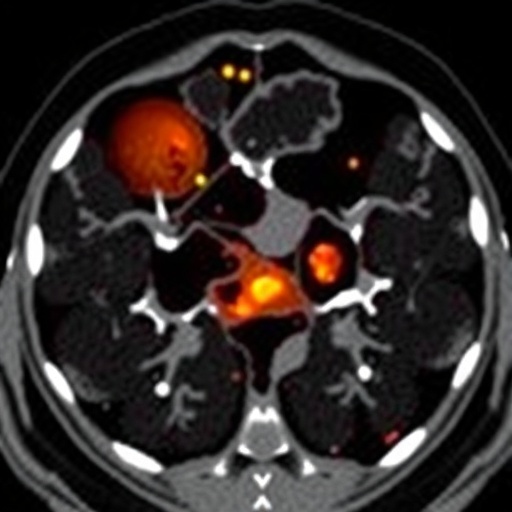 ai-classifies-ct-scans-in-coal-pneumoconiosis