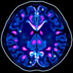 mri-radiomics-predicts-egfr-mutations-accurately